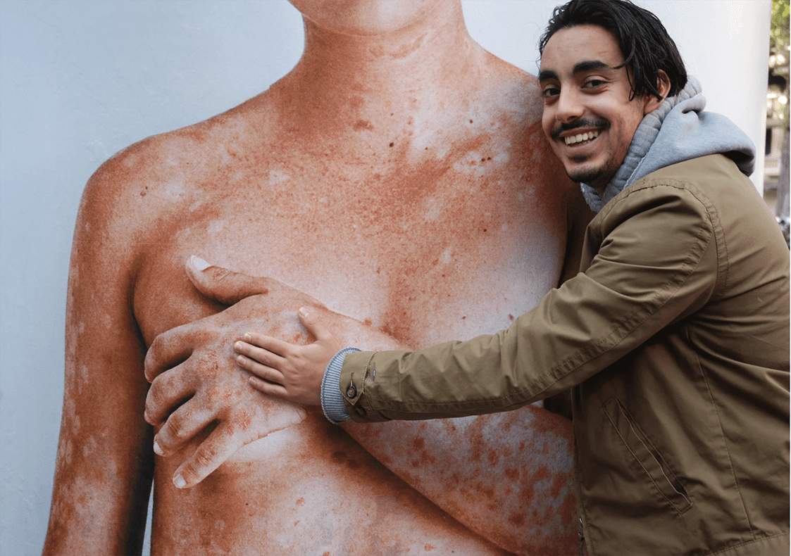 Omarm Psoriasis